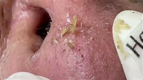 Blackhead extractions on Happy&39;s nose. . Blackhead extraction on nose videos